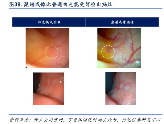 各位网友请教一下. 聚谱成像比普通白光能更好检出病灶