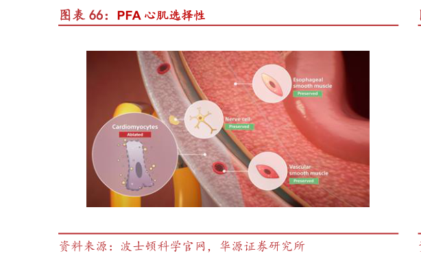 如何了解PFA 心肌选择性