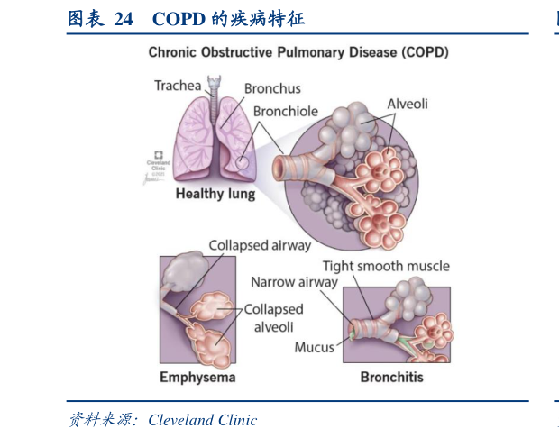 如何了解COPD 的疾病特征