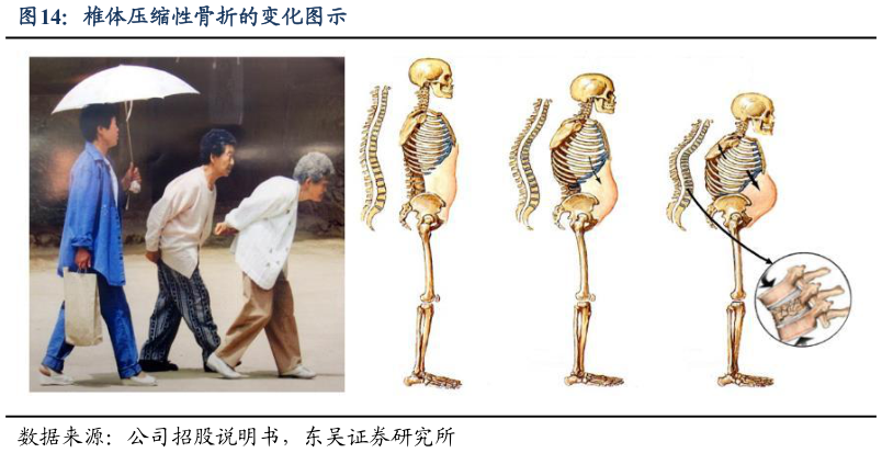 咨询大家椎体压缩性骨折的变化图示