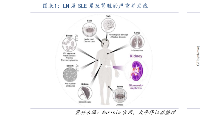 如何了解LN 是 SLE 累及肾脏的严重并发症?