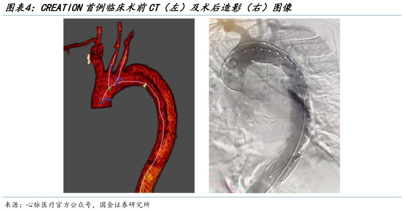 如何才能CREATION首例临床术前CT(左)及术后造影(右)图像?