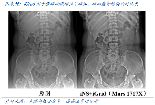 各位网友请教一下iGrad用于腰椎拍摄增强了椎体、椎间盘等结构的对比度?