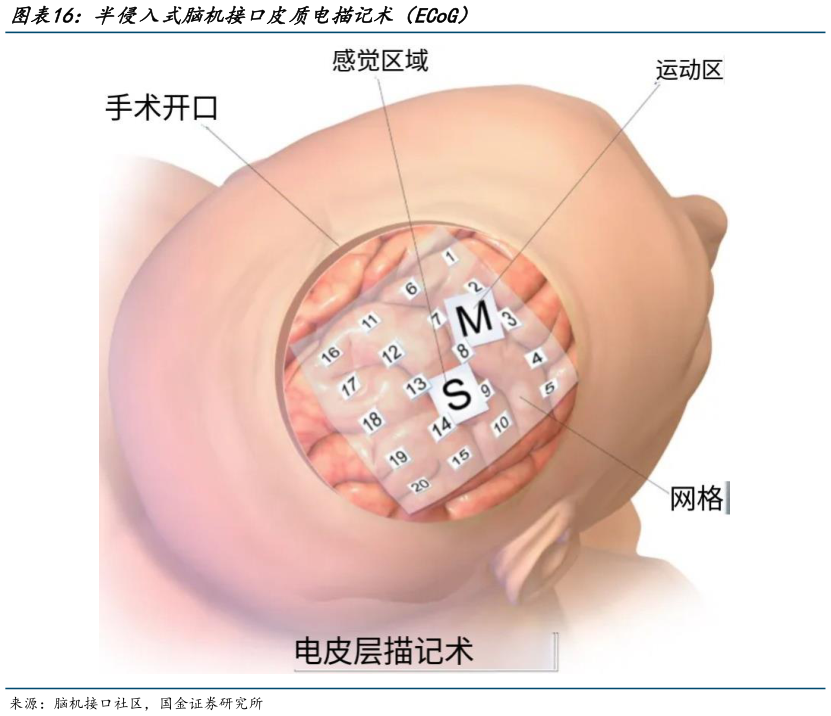 一起讨论下半侵入式脑机接口皮质电描记术（ECoG）