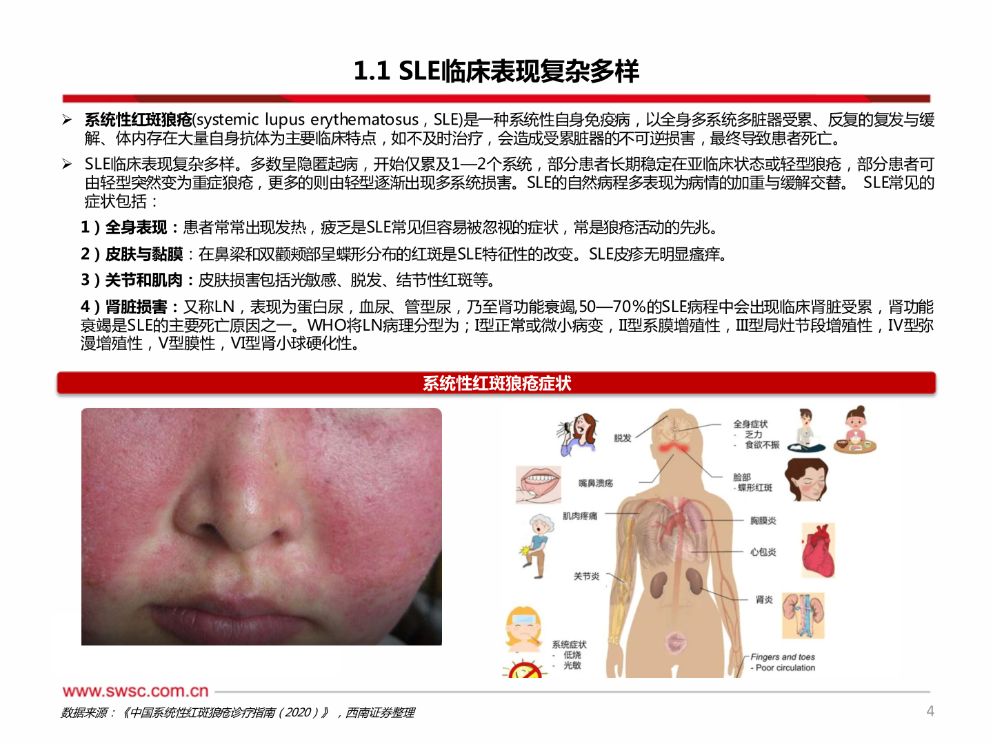 如何看待1.1 SLE临床表现复杂多样?