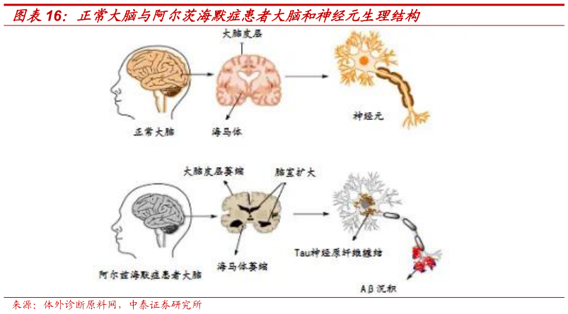 如何看待正常大脑与阿尔茨海默症患者大脑和神经元生理结构