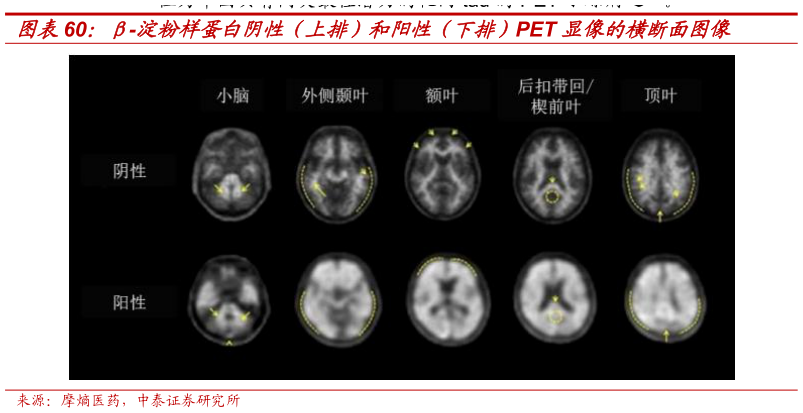 你知道-淀粉样蛋白阴性（上排）和阳性（下排）PET 显像的横断面图像
